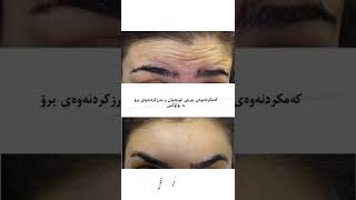 Botox for forehead wrinkles