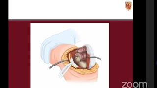 STOMP Approach for Elbow Arthroplasty