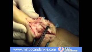 Scarf Akin Procedure for Bunion Correction x264