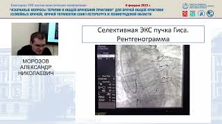 Особенности анализа ЭКГ у пациентов с имплантированными антиаритмическими устройствами