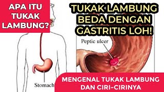 MENGENAL PENYAKIT TUKAK LAMBUNG DAN CIRI-CIRINYA