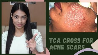 TCA cross for acne scars || Questions & Answers video || टीसीए क्रॉस क्या है और यह कैसे काम करता है?