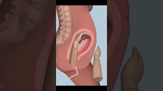 How to remove placenta#viral#youtubeshorts#shorts#short#trending#shortvideo#viralvideo#nursing#child