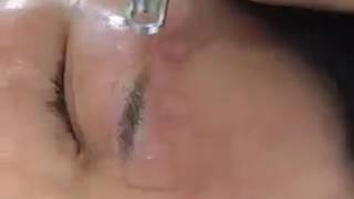 Mini Nd.Yag laser eyebrow removal