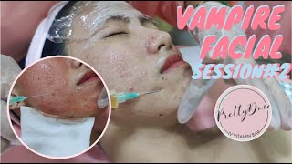 VAMPIRE FACIAL SCAR TREATMENT (SESSION#2 AND RESULT) | PRETTYDOSE DAVAO