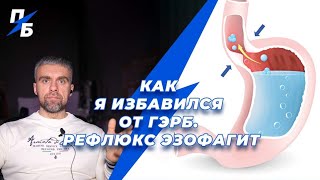 Как я избавился от ГЭРБ. Рефлюкс эзофагит