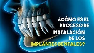 ✅ Implantes Dentales en Lima Perú 🔴 Paso a Paso