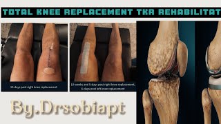 Total Knee Replacement Surgery |Total Knee Knee Replacement Exercises | Post op rehabilitation