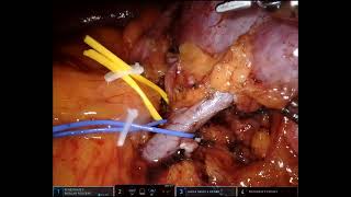 #214 Intra-Arterial Renal Hypothermia for Complex Endophytic/Hilar Tumors- Dr. Joris Vangeneugden