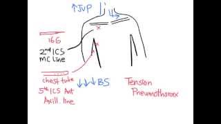 Chest pain (Pneumothorax)