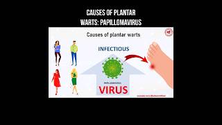 Causes of plantar warts: papillomavirus #plantarwart #papillomavirus #warts #virus