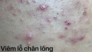 Seri Nặn Mụn-Part 25 Viêm lỗ chân lông nhân mụn sẽ như thế nào?