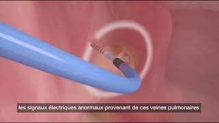 Comment fonctionne l ablation par cathéter?