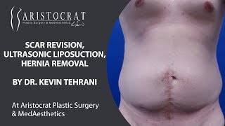 Male Before + After Scar Revision + Liposuction