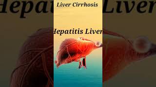 liver Cirrhosis short knowledge