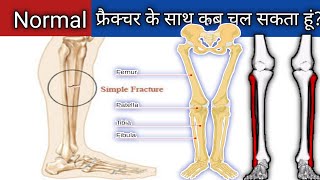 Normal Fracture Ketne Dino Main Jud Jata Hai || Tibia Fibula Fracture Recovery || Skin Grafting