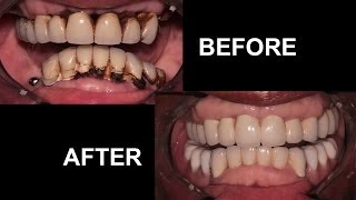 Dental Implants