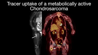 Chondrosarcoma Case 1: Femur