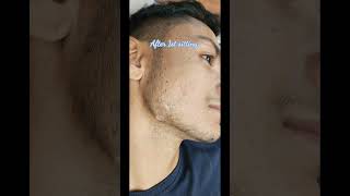 Acne Keloidal Scar Treatment || Before and After results of 2 sittings #shorts #acne #treatment