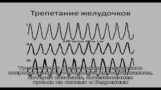 Трепетание желудочков