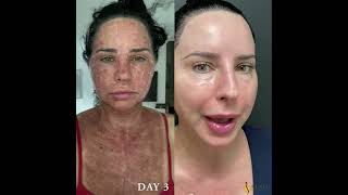 UltraClear Laser Weston Florida, Patient Discusses her recent treatment with 7 days of photos