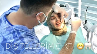 DİŞ TELLERİM ÇIKTIII!!! 🥳🦷  tedavi süreci nasıldı, nelere dikkat edilmeli?