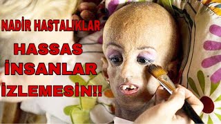 TEDAVİSİ OLMAYAN//NADİR HASTALIKLAR   #inanılmazbedenler #SıraDışıBedenler  #nadirhastalıklar