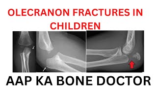 OLECRANON FRACTURES IN CHILDREN (ELBOW) - EPISODE 67