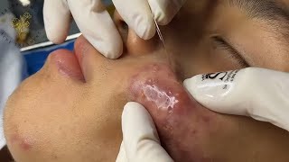 Big Cystic Acne Blackheads Extraction Blackheads & Milia, Whiteheads Removal Pimple Popping #PA282