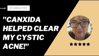 My Candida Story: CanXida Helped Clear My Cystic Acne!