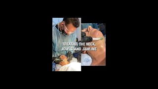 Treating the Neck, Jowls, and Jawline Using FaceTite and Vaser Microliposuction.