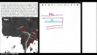 COMPRESSION OF OCCULOMOTOR NERVE