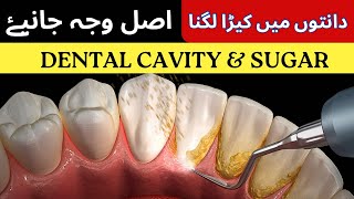 Dental Cavity [Tooth Decay] | Permanent Solution for Dental Cavity | دانتوں میں کیڑا لگنے کی وجہ