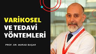 VARİKOSEL NEDİR VE NASIL TEDAVİ EDİLİR  DR  MEHMET MURAD BAŞAR