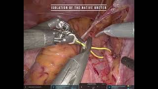 #353  Robot assisted 3D models-guided ureteral reimplantation- Dr.Federico Lavagno