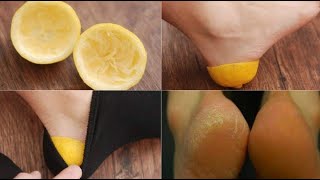 Une ancienne astuce au citron pour soigner les talons rugueux et fissurés en 30 minutes