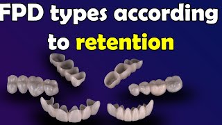 Fixed Partial Denture "Bridge" types according to the retention