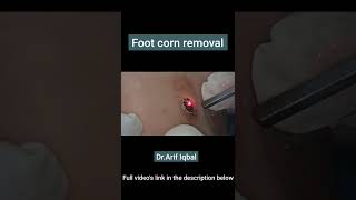 foot corn removal #drarifiqbal