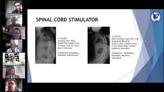 Pediatric Neuromodulation -Live Webinar