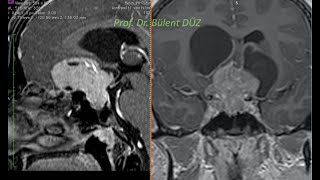 Hipofiz adenomu mikrocerrahi ameliyat Prof  Dr  Bülent DÜZ