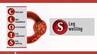 Leg Swelling - The Final Symptom in CLOTS