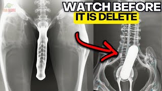 Doctors Were STUNNED: 16 Creepiest Things Found in X-Rays! Documentary