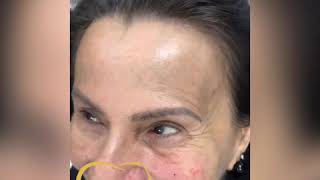 PREENCHIMENTO FACIAL