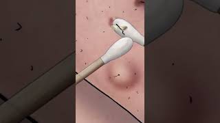 Pumple and Blackheads Removing