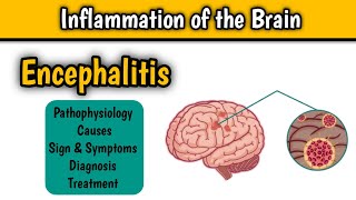 Encephalitis || inflammation of the brain ||pathophysiology,causes, sign & symptoms, diagnosis,Treat