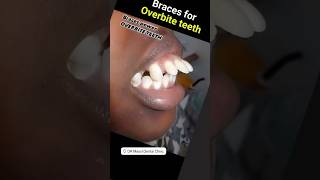 Braces Power for severe Overbite