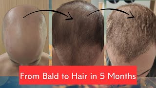 5 month update on my hair transplant from Turkey | Istanbul | Close up pictures and video | Dr Cinik