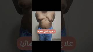 من اليمن 🇾🇪 علاج التثدى نهائيا د محمد الهيتمى