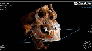 Virtual Implant Treatment Plan Simulation