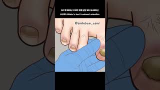 ASMR 오래된 무좀 발톱 케어 애니메이션 | Athlete's foot treatment animation #shorts #treatment #dentalcare